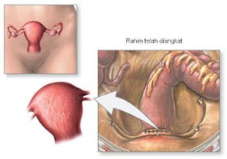  Kanker Rahim yakni tumor ganas pada endometrium  Kanker Rahim : tumor ganas pada endometrium