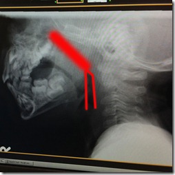 xray1 xray1