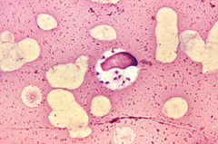 阿富汗 毀容病 - Leishmaniasis 侵襲阿富汗的毀容病