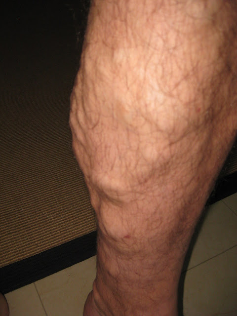 Varicose veins: causes: treatment and prevention