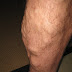 Varicose veins: causes: treatment and prevention