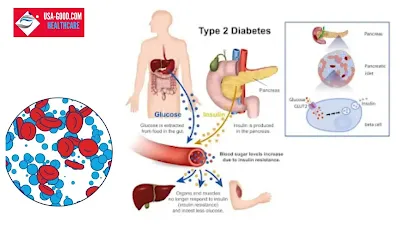 What is Type 2 diabetes?