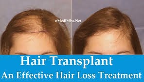 hair loss treatment | hair loss treatment for women | hair loss treatment diy | hair loss treatment men | hair loss treatment for women remedies | hair loss treatment products | hair loss treatment vitamins | hair loss treatment for women products | Hair Restoration Laboratories | Hair Loss Treatments | ALOPECIA AREATA HOSPITAL - HAIR LOSS TREATMENT | Satyam Hair Transplant in India Hair Loss, Hair fall, Baldness Treatment, Men Women hair restoration |