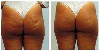 Mesotherapy Pictures