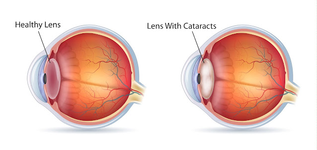 Diabetic Retinopathy