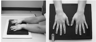 broken hand xray