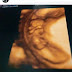 GAMBAR IMBASAN ULTRASOUND BAYI KANDUNGAN CHE TA