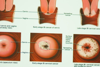 Early stage cervical cancer