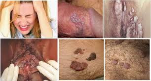 Mengobati kutil dengan bawang merah