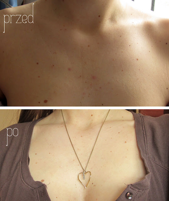 Mój dekolt przed i po kuracji kosmetykami Pat&Rub / foto 