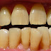 Vì sao răng nhiễm tetracycline