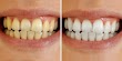 DIY: See How to Whiten Your Teeth In Just 3 Minutes