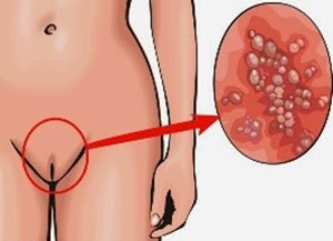Gatal-Gatal Pada Vagina