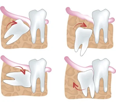  Răng khôn mọc ở vị trí nào