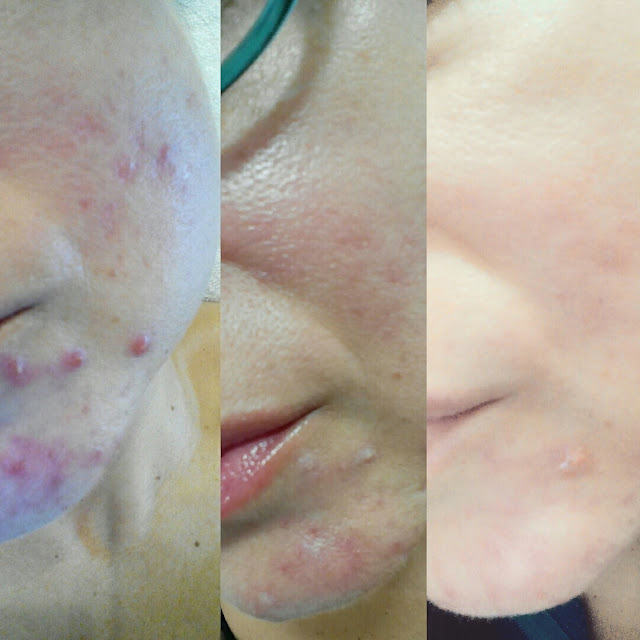 evolucion-acne