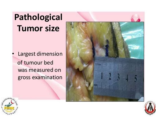 peritoneal mesothelioma