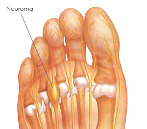 mortons a of by    neuroma common neuroma for is symptoms non a pain shoes foot identified neuroma