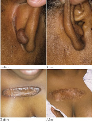 Other minor injuries that can trigger keloids are burns and piercings.