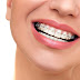 Niềng răng thưa- Giải pháp hiệu quả