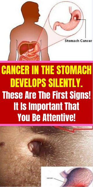 Cancer In The Stomach Develops Silently. These Are The First Signs! It Is Important That You Be Attentive!