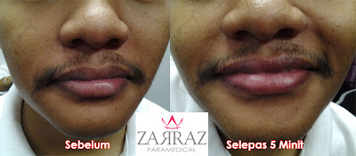 testimoni pengguna lip magic collagen zarraz paramedical, masalah bibir kering, masalah bibir hitam, kenapa bibir menjadi kering, rawatan masalah bibir