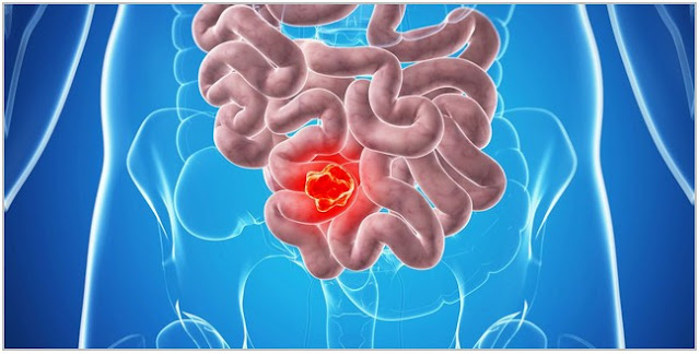 Tips Menurunkan Risiko Kanker Usus