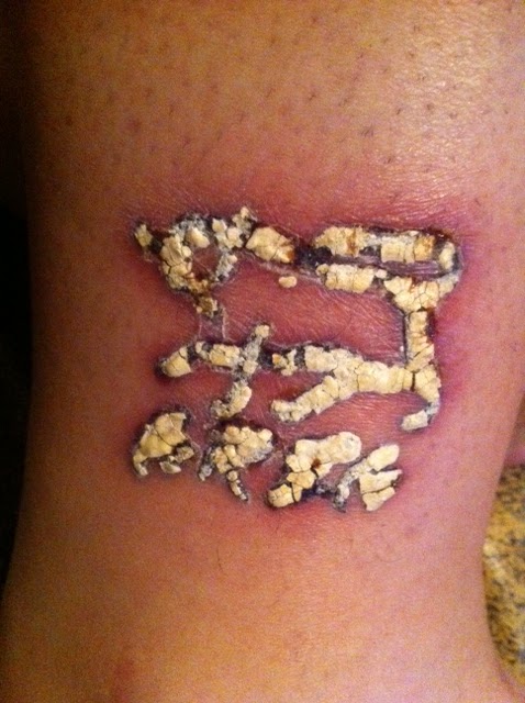 Tattoo Itching Scabbing