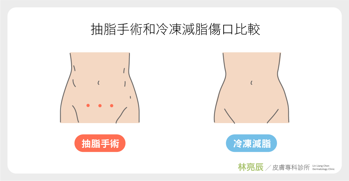 抽脂手術與冷凍減脂術後傷口比較在於冷凍減脂術後不留下傷口