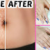 How To Remove STRETCH MARKS Removal Cream - Guaranteed Results In Just 2 Weeks