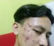 Mengatasi Jerawat Mendem
