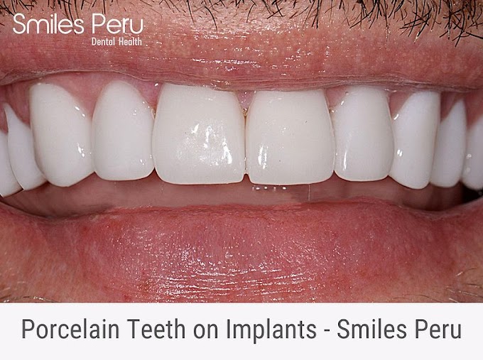 Porcelain Teeth on Implants - Smiles Peru