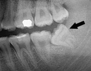 Răng khôn mọc ngầm có hại không?