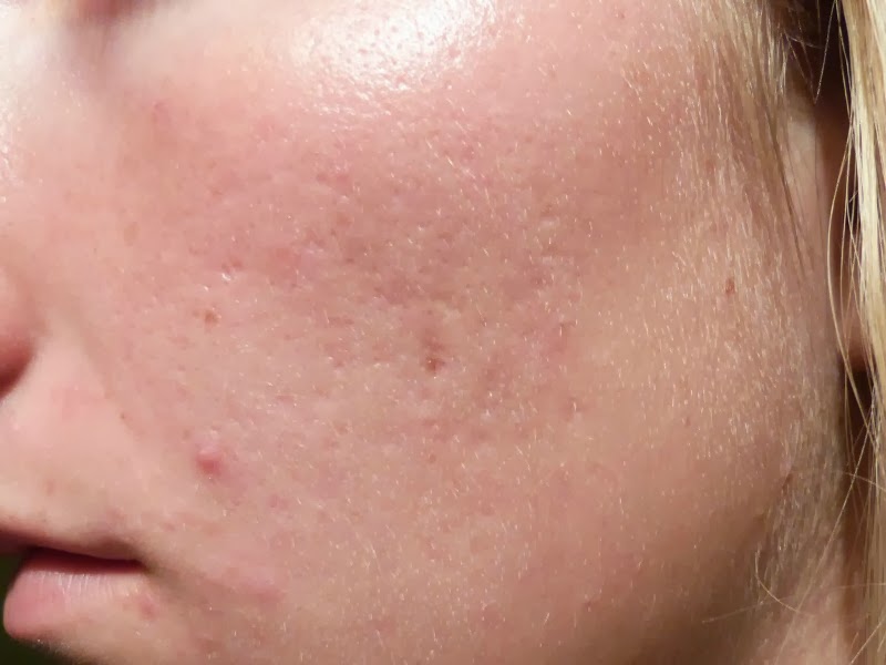 How To Get Rid Of Pitted Acne Scars How to get rid of acne scars