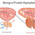 Askep Benigna Prostat Hiperplasia (BPH) Terlengkap