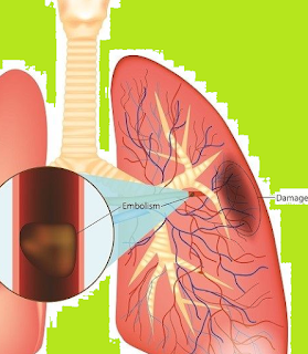 pulmonary embolism, pulmonary embolism symptoms, symptoms of pulmonary embolism, pulmonary embolism treatment, what is a pulmonary embolism, pulmonary embolism icd 10, signs of pulmonary embolism, saddle pulmonary embolism, icd 10 code for pulmonary embolism, what is pulmonary embolism, pulmonary embolism treatments, pulmonary embolism causes, how long can you have a pulmonary embolism without knowing, life expectancy after pulmonary embolism, cause of pulmonary embolism, bilateral pulmonary embolism, how long before a pulmonary embolism kills you, icd 10 pulmonary embolism, how long can you have pulmonary embolism without knowing, pulmonary embolism medication, signs and symptoms of pulmonary embolism, pulmonary embolism diagnosis, pulmonary embolism ecg, what causes pulmonary embolism, signs and symptoms of a pulmonary embolism, pulmonary embolism sleeping position, stages of pulmonary embolism, pulmonary embolism x ray, pulmonary embolism xray, acute pulmonary embolism, signs of a pulmonary embolism, what is the first sign of pulmonary embolism, treatment for pulmonary embolism, what does pulmonary embolism feel like, what does a pulmonary embolism feel like, pulmonary embolism chest pain location, history of pulmonary embolism icd 10, symptoms of a pulmonary embolism, pulmonary embolism risk factors, pulmonary embolism signs and symptoms, causes of pulmonary embolism, pulmonary embolism test, test for pulmonary embolism, what causes a pulmonary embolism, pulmonary embolism survival rate by age, pulmonary embolism death, tests for pulmonary embolism, how to prevent pulmonary embolism, what are the warning signs of a pulmonary embolism, bilateral pulmonary embolism icd 10, testing for pulmonary embolism, pulmonary embolism pain, acute pulmonary embolism icd 10, pulmonary embolism tests, ct angiogram chest pulmonary embolism w contrast, d-dimer range for pulmonary embolism, icd 10 code for history of pulmonary embolism, pulmonary embolism back pain, pulmonary embolism survival rate, pulmonary embolism complications, pulmonary embolism covid, pulmonary embolism pregnancy, icd 10 for pulmonary embolism, ct scan pulmonary embolism, how to prevent a pulmonary embolism, pulmonary embolism doctor, chest x ray pulmonary embolism, complications of pulmonary embolism, how to diagnose a pulmonary embolism, christina desantis pulmonary embolism, icd 10 code pulmonary embolism, dvt pulmonary embolism, pulmonary embolism on chest x ray, ct chest pulmonary embolism protocol, pulmonary embolism chest x ray, how to diagnose pulmonary embolism, how to treat pulmonary embolism, pulmonary embolism nursing diagnosis, pulmonary embolism definition, pulmonary embolism prevention, icd 10 code for bilateral pulmonary embolism, pulmonary embolism diagnostic test, pulmonary embolism after surgery, icd 10 history of pulmonary embolism, what is a saddle pulmonary embolism, what are the symptoms of a pulmonary embolism, what is saddle pulmonary embolism, pulmonary embolism., pulmonary embolism pain in back, diagnostic test for pulmonary embolism, symptoms pulmonary embolism, diagnostic tests for pulmonary embolism, pulmonary embolism postpartum, preventing pulmonary embolism, nursing diagnosis for pulmonary embolism, icd 10 code for acute pulmonary embolism, pulmonary embolism videos, pulmonary embolism mortality rate, prevention of pulmonary embolism, pulmonary embolism in spanish,