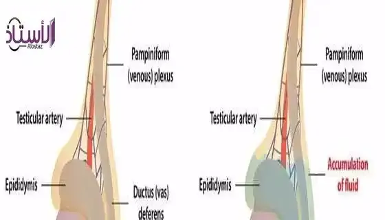Testicular-hematoma