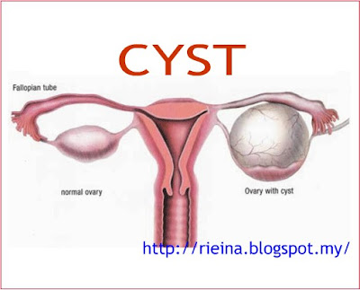 Cyst Pcos