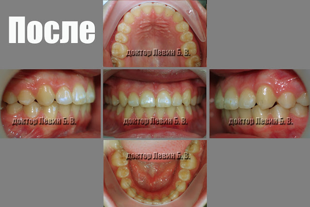 Три фото зубов характеризующие прикус пациента после ортодонтического лечения