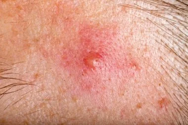 What in the World is Cystic Acne?