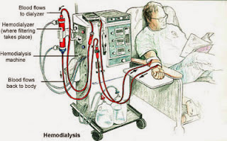 Hasil gambar untuk gambar hemodialisis