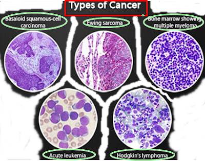 Mesothelioma Lung Cancer Cell Types