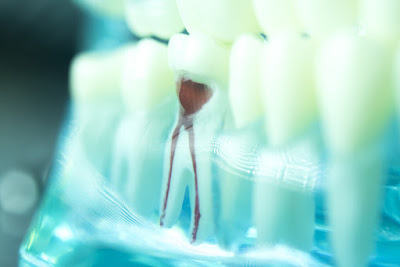Root Canal Treatment What Are Its Advantages And Risks