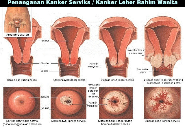 Penanganan Kanker Serviks / Kanker Leher Rahim Wanita