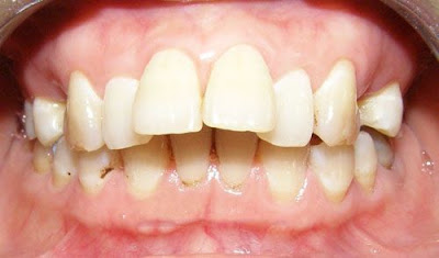 Răng hô hàm trên gây mất thẩm mỹ