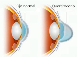 Queratocono