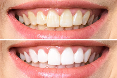 انواع تبييض الاسنان واسعارها