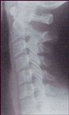 cervical spine x=ray showing a loss of cervical curve