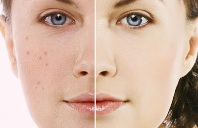 The Truth About Removing Acne Scarring