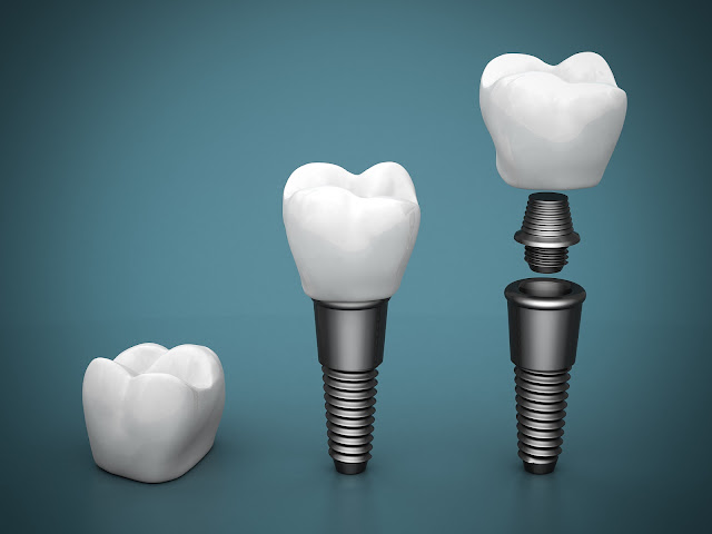 How Tooth Implants Can Improve Your Sleep?
