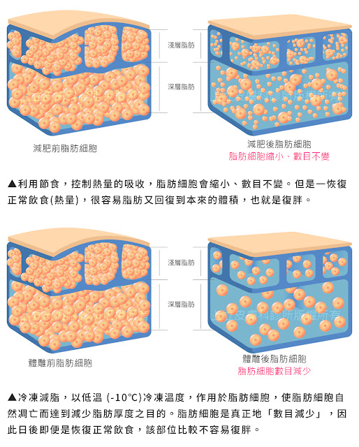 MICOOL-S冷凍溶脂副作用冷凍溶脂價錢冷凍減脂心得冷凍溶脂手臂冷凍溶脂推薦上立皮膚科診所林上立醫師